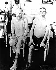 Otros prisioneros sufrieron importantes deformaciones y mutilaciones a consecuencia de los experimentos nazis
